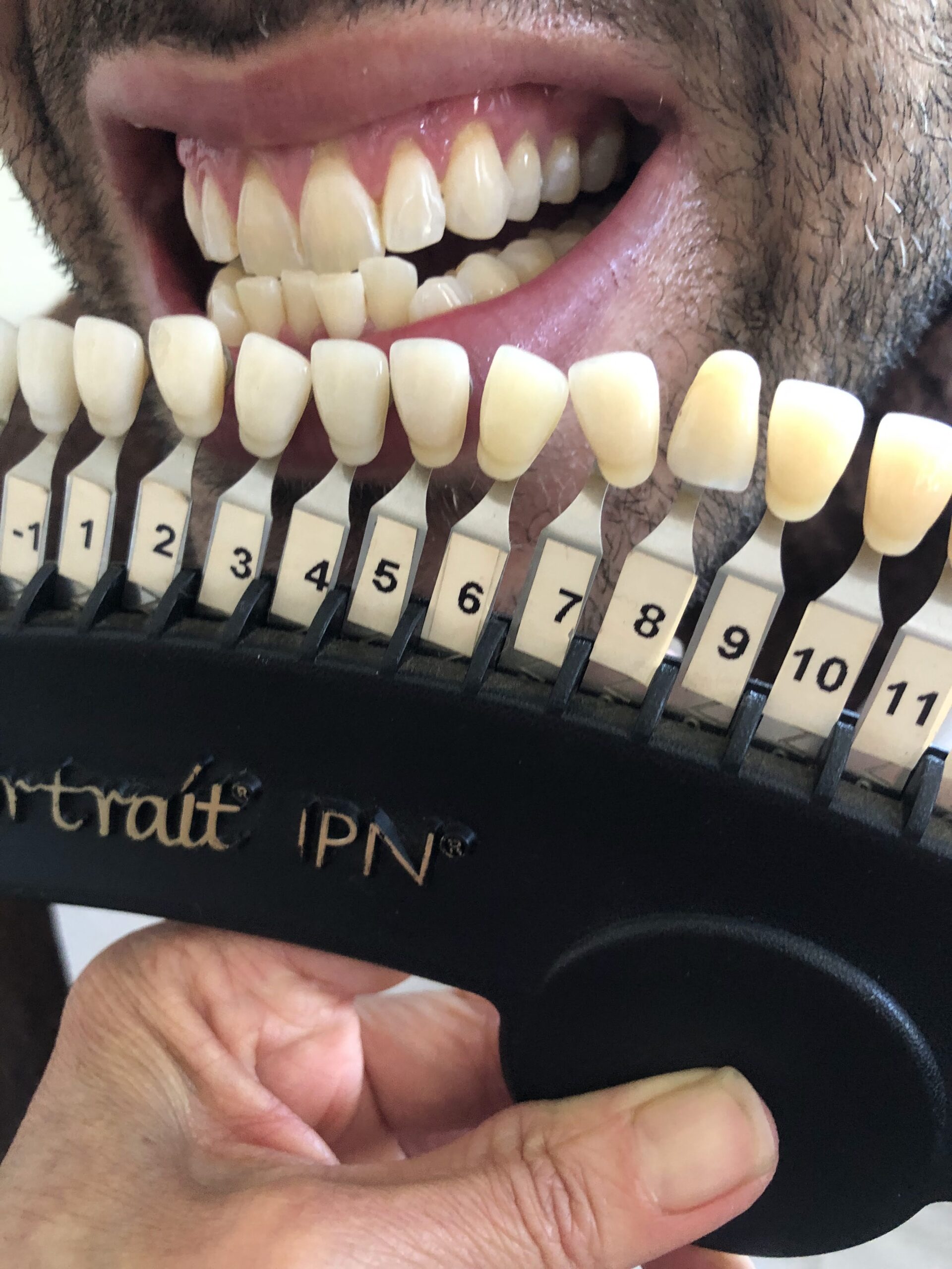 davinci teeth whitening for sensitive teeth